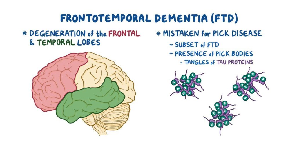 Frontotemporal Dementia - How many people suffering with it in the USA - Causes and symptoms | Image Credit: osmosis.org