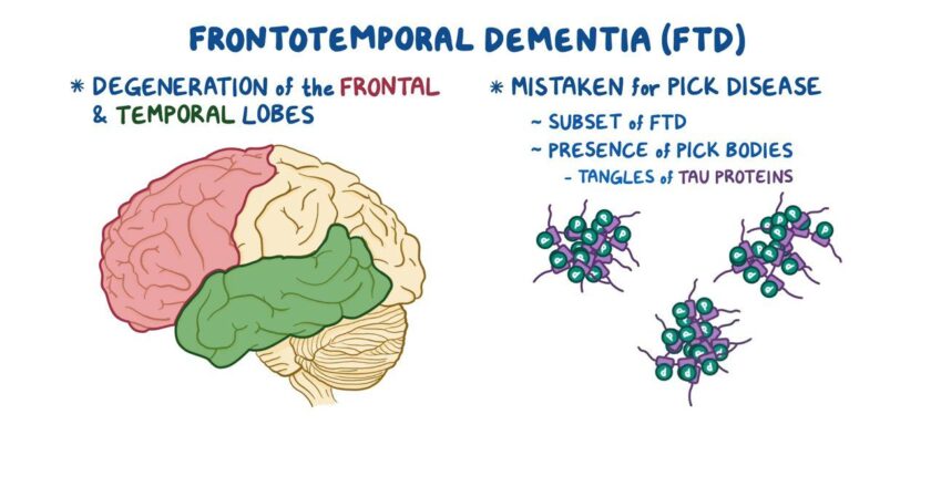 Frontotemporal Dementia – How many people suffering with it in the USA – Causes and symptoms