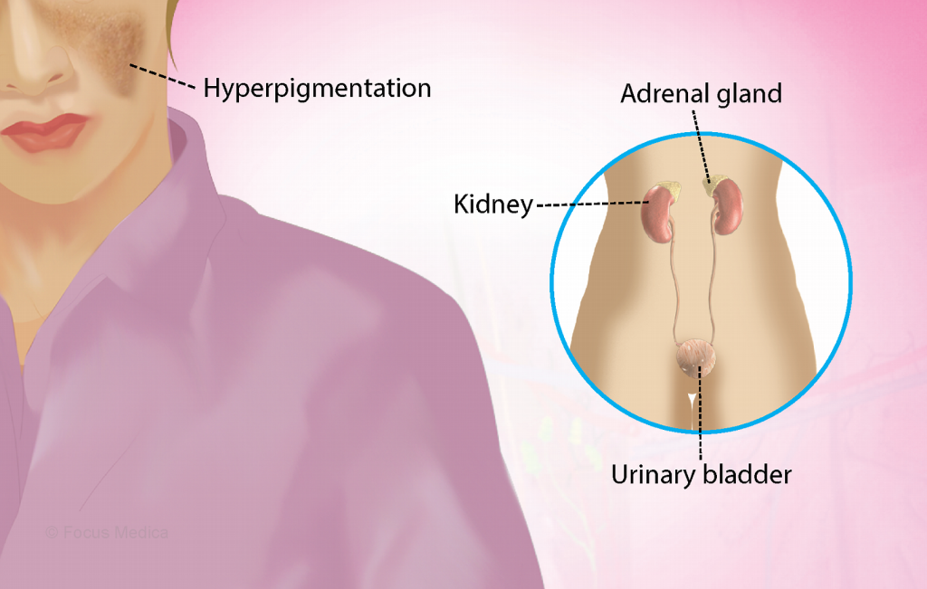 Addison’s Disease Rare Condition | Image Credit: msn.com