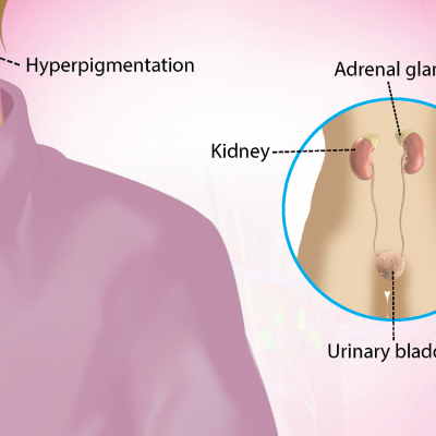 Breaking News – Addison’s Disease Rare Condition Affecting the Adrenal Glands