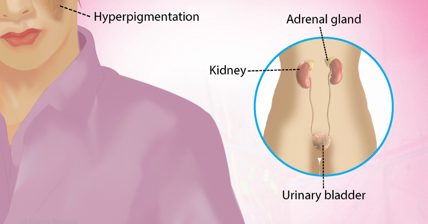 Breaking News – Addison’s Disease Rare Condition Affecting the Adrenal Glands