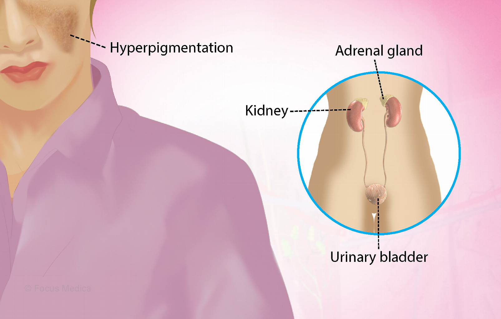 Breaking News – Addison’s Disease Rare Condition Affecting the Adrenal Glands